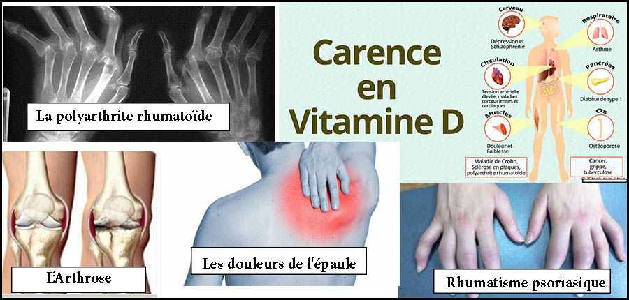 Comment faire changer le visage des maladies rhumatismales les plus fréquentes au Maroc ?