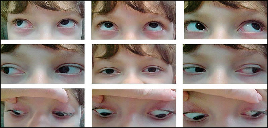 Psychotraumatismes: l’apport de la technique thérapeutique EMDR